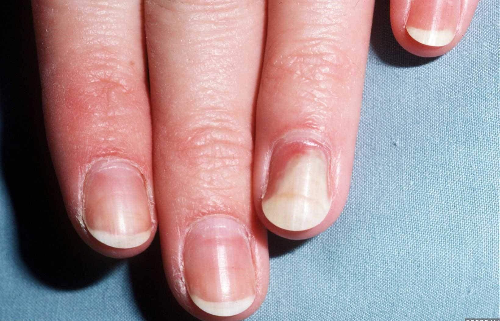 Заболевание ногтей онихолизис ногтей